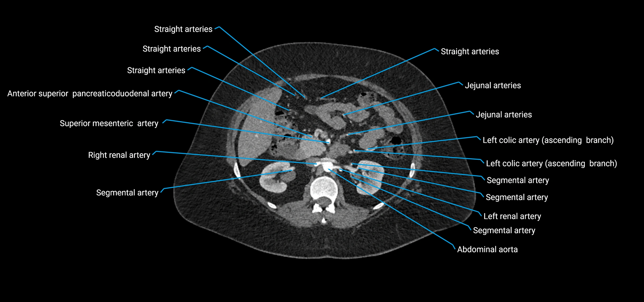 CTA abdomen axial cross sectional anatomy labelled image_73 (2).webp